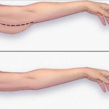 Arm Restraint Aesthetics (Brakioplasti)