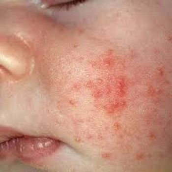 Atopic Eczema (Atopic Dermatitis)