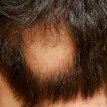 مصفف شعر (Alopecia Areata)