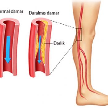 احتقان الأوعية الدموية في الساق