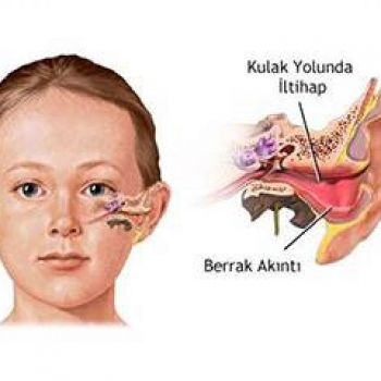 Dış Kulak Yolu Enfeksiyonu