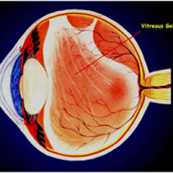 Retina Dekolmanı